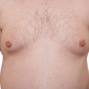 Gynecomastia - breast reduction for men